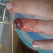 Ulykke med finger