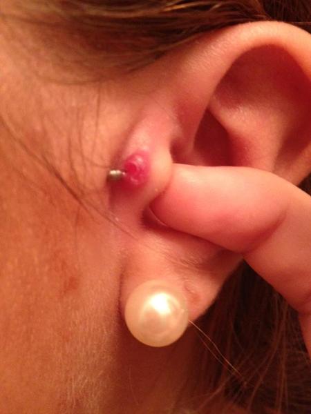 kæmpe byld betændelse ved tragus piercing