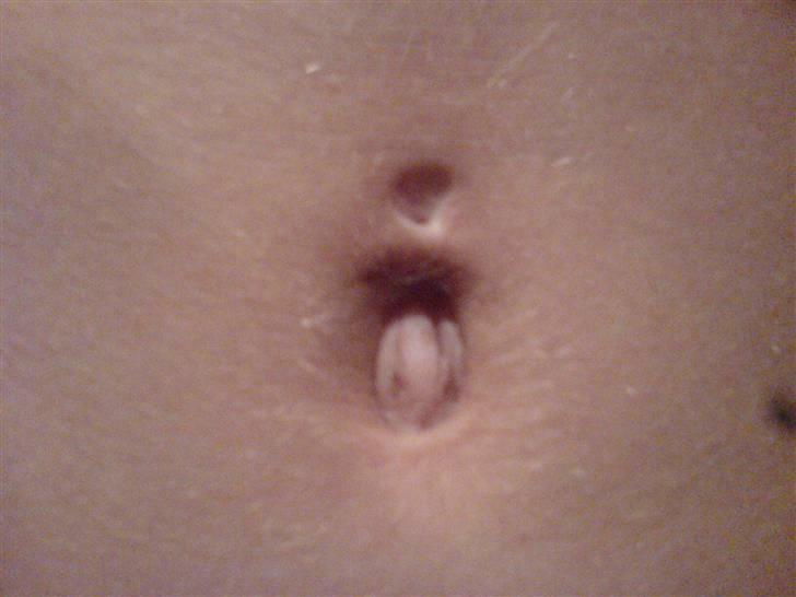 Kvinde Tanja - Min ødelagte navle. Lod den sidde i selvom den var ved at gro ud, og det er så resulatet a det.  billede 5