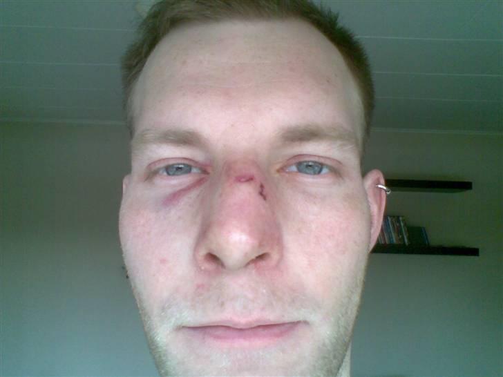 Mand skovmusen - dagen efter mit stunt ... der var et dæk der sprang i luften og op i hovede på mig .. billede 13