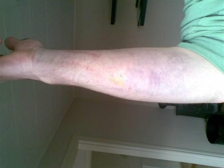 Mand skovmusen - dagen efter mit stunt ... der var et dæk der sprang i luften og op i hovede på mig .. billede 14