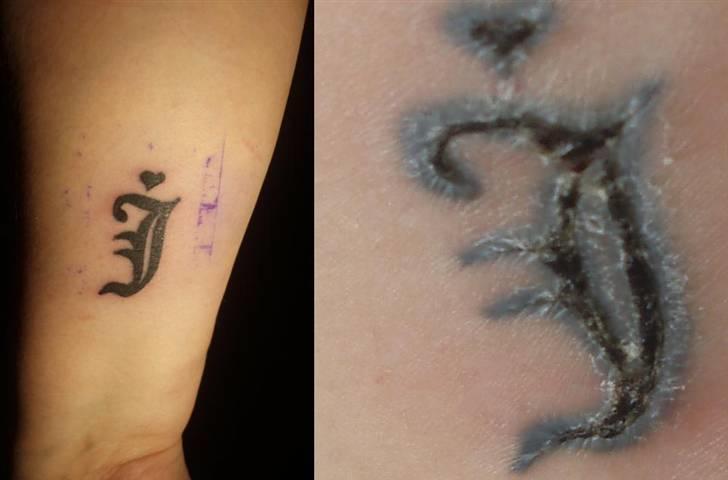 Kvinde Johanna - Min tattoo. På billedet til venstre er det taget samme dag den blev lavet, d. 7. april, og på det til højre er taget i dag, 17. april. billede 7
