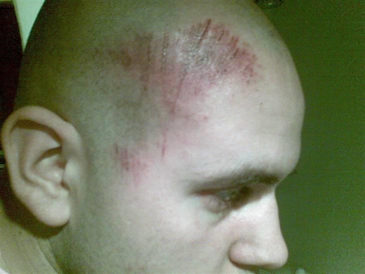 Mand Nicholai - Tja en bytur i svendborg. Endte med at politet kørte mig på skadestuen, Havde fået hjernerystelse, så husker Stort set intet... billede 10