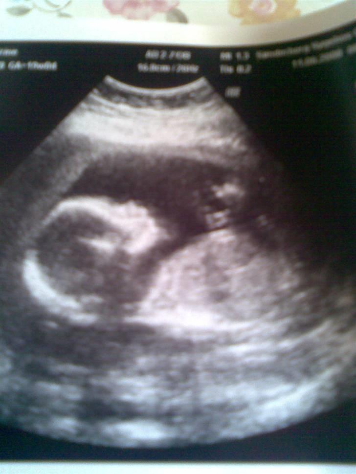 Gravid billeder - Billede fra misdannelses scanning, d.11 Juni 2008 - Uge 19 :)
Fin lille dreng! billede 2