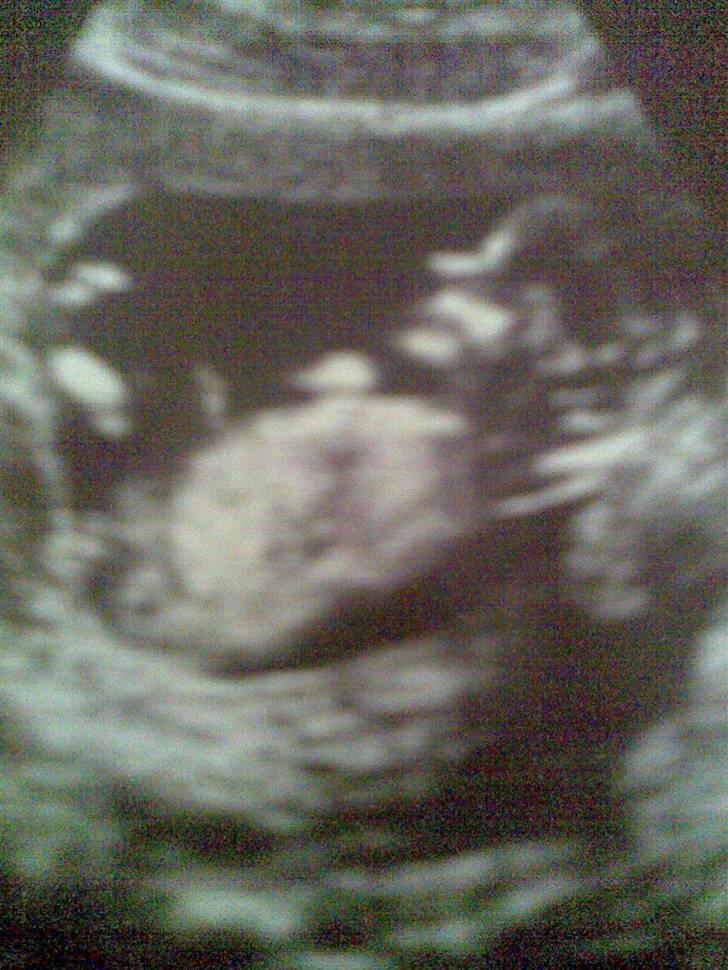 Gravid billeder - Billede fra nakkefolds scanning, d.29 April 2008 - Uge 12+6 :)
Alt var som det sku være! billede 1