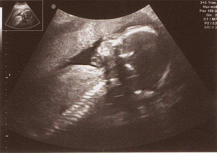 Graviditeten <3 Uge 20-uge 38 - MD scanningen - hulen gemmer på en dejlig dreng <3 
20+5 billede 3
