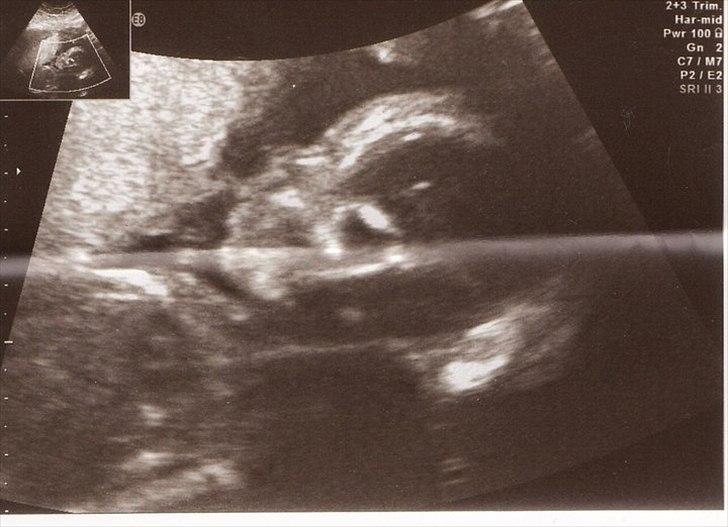 Graviditeten <3 Uge 20-uge 38 - MD scanningen - hulen gemmer på en dejlig dreng <3 
20+5 billede 4