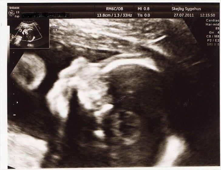 Graviditeten <3 Uge 20-uge 38 - Scanning - Baby drengens hoved <3
21+3 billede 2