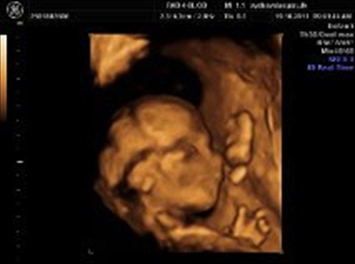 Kønsscanning og 3d fra i dag 17+3 billede 6
