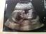 Baby 2012 - Misdannelses scanningen :)