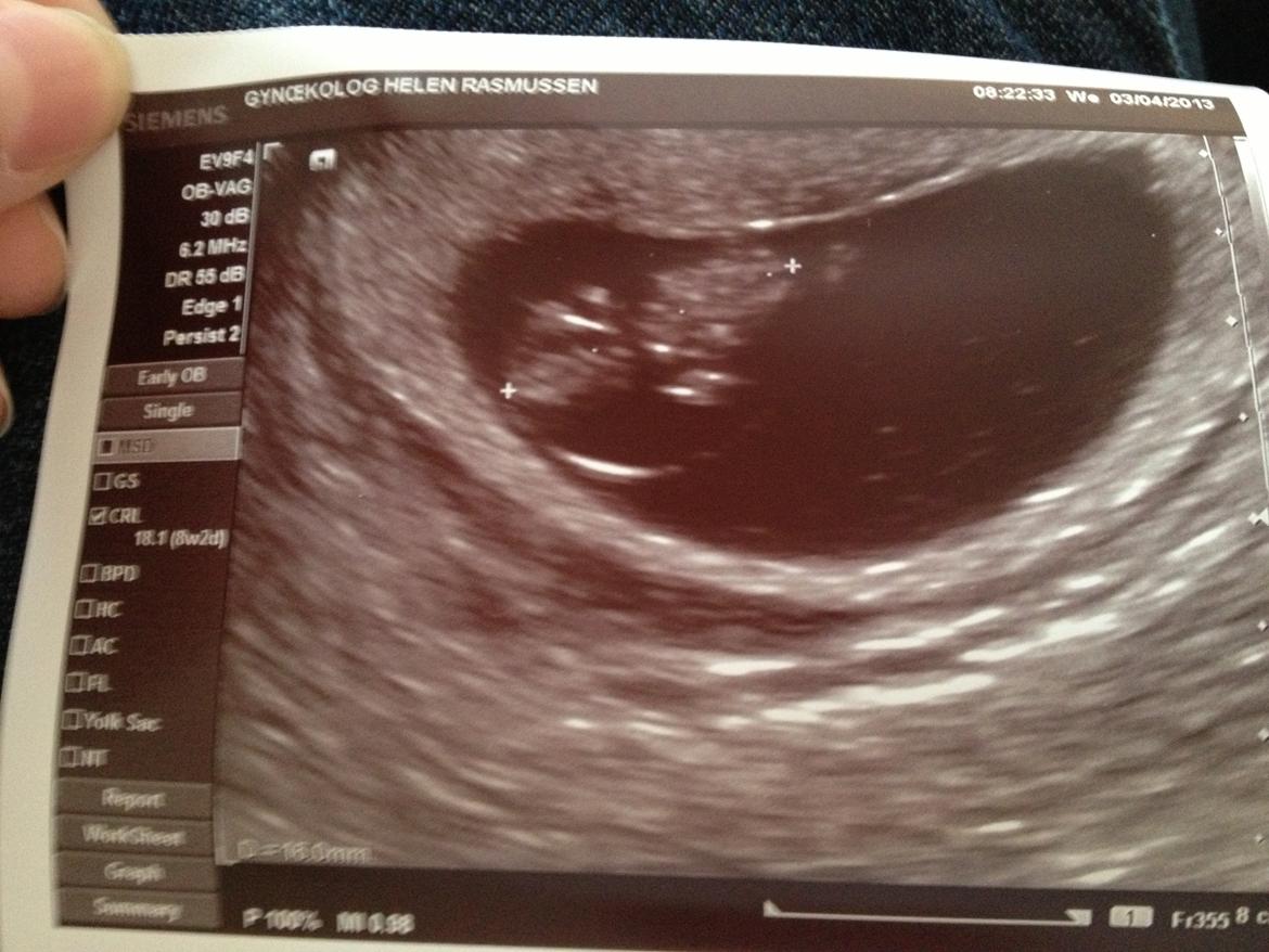 Min graviditet med tvillingerne <3 - Den ene tvilling.. Den ligger med siden til, og den anden ligger så den "kigger" på os.
8+2 billede 9