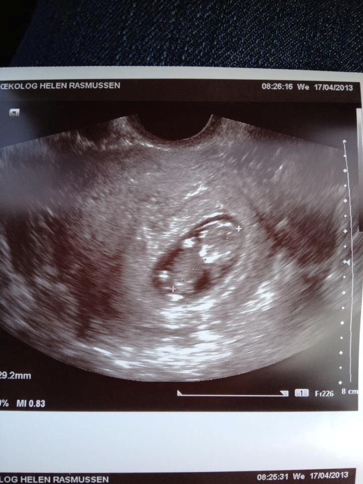 Min graviditet med tvillingerne <3 - 10+2.
Tvilling B.
 billede 13
