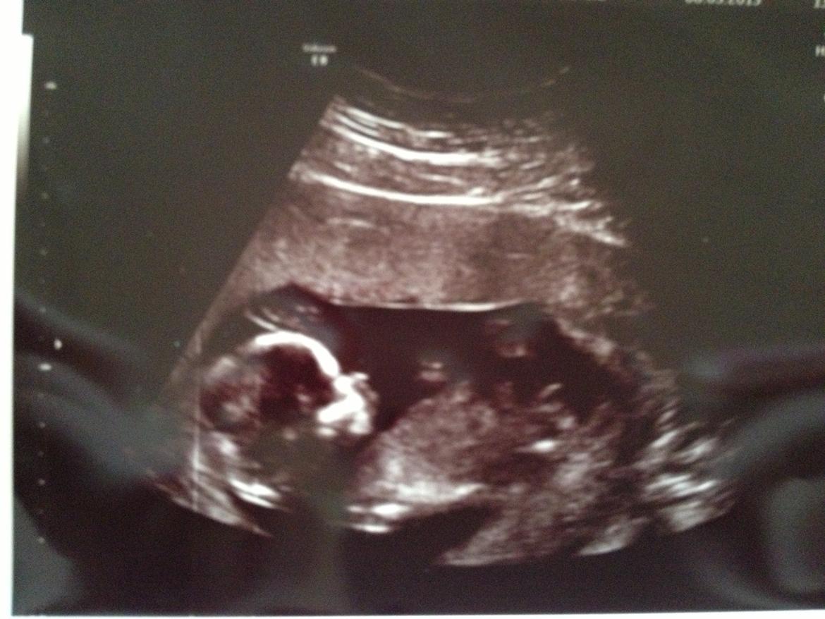 Min graviditet med tvillingerne <3 - NF.
Terminen blev rykket til d. 7/11-13. Så er 13+6 her.  billede 17