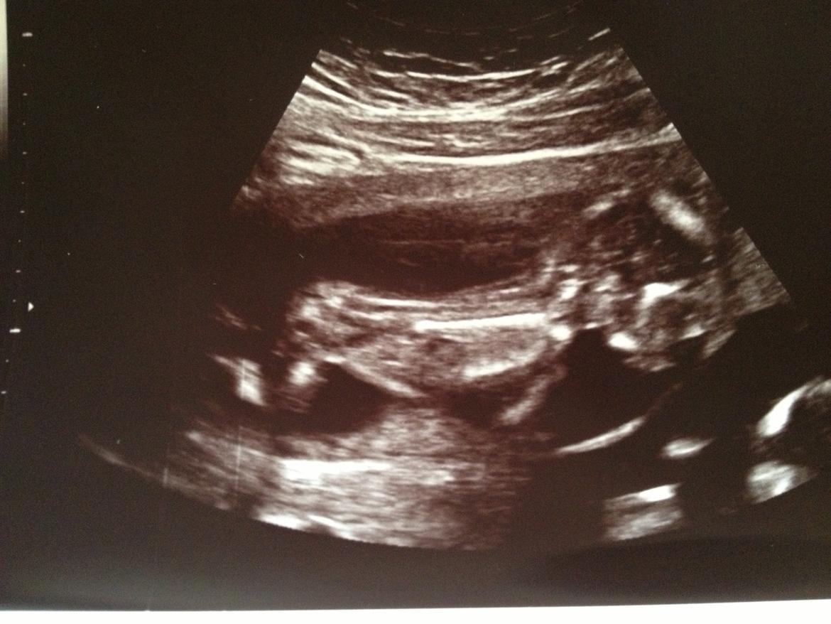 Min graviditet med tvillingerne <3 - NF.
Terminen blev rykket til d. 7/11-13. Så er 13+6 her.  billede 18
