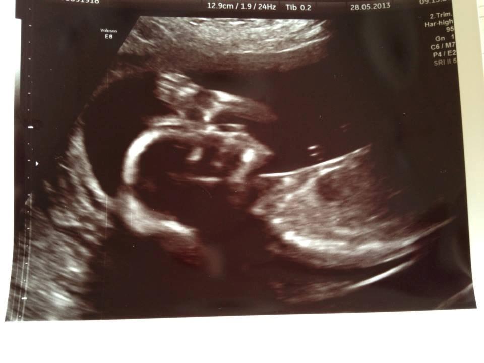 Min graviditet med tvillingerne <3 - Emma 16+5.  billede 28