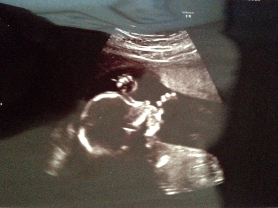 Min graviditet med tvillingerne <3 - MD scanning. 
19+5. 
Emma der sutter tommelfinger <3 billede 34