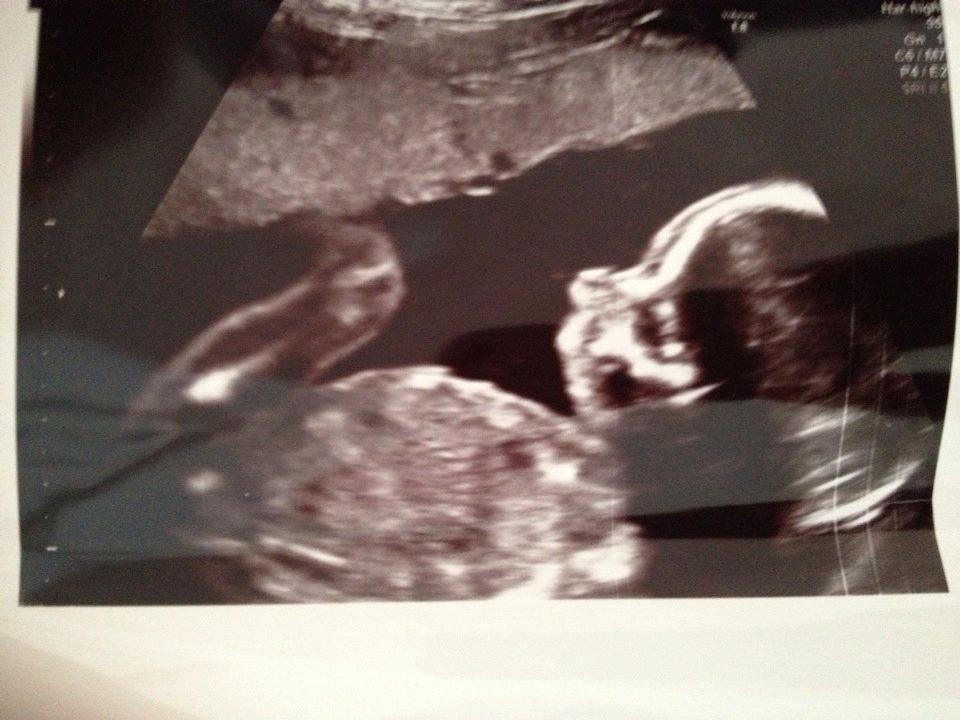Min graviditet med tvillingerne <3 - MD scanning. 19+5. Waldemar. Han lå og drak fostervand <3 billede 35