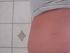 Opsvulmet pga. homonbehandling (under IVF-behandling)