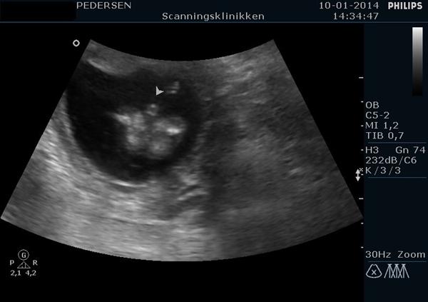 Vi har været til kønsscanning
