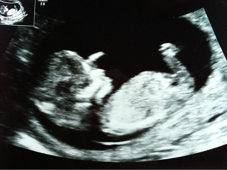 Dreng William Anker Paysen Kjærsgaard - lille fin dreng til nakkefoldscanning :) lægen sagde at han lå rigtig godt så hun tog en masse billeder af ham billede 1