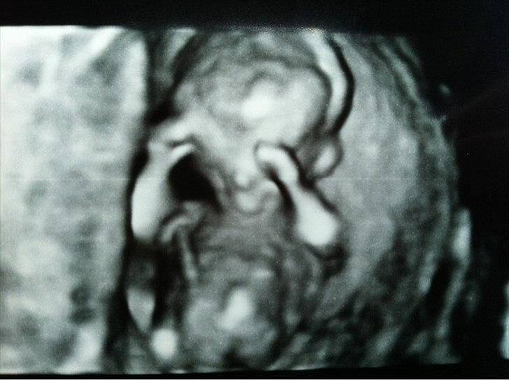 Dreng William Anker Paysen Kjærsgaard - lile mand i en 3D scanning 
Han ligner jo sin far som når han ligger der og ligner en bokser billede 2