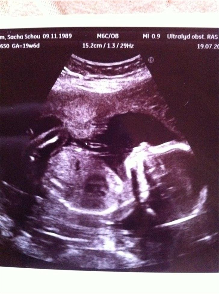 Pige Jolene marie ravn stausholm - Anden scanning uge 20-0. billede 4