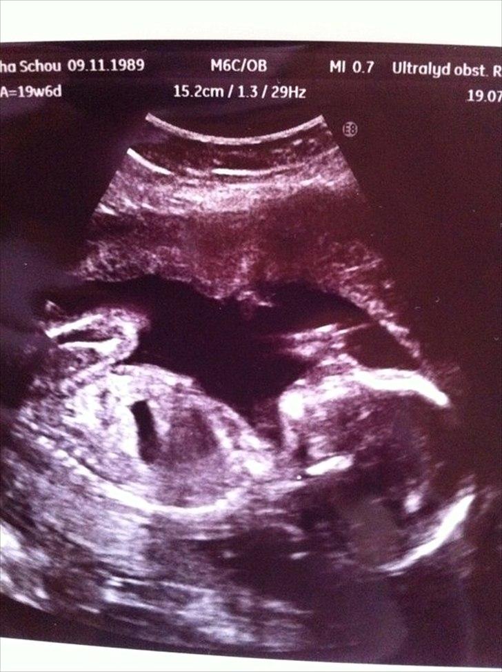 Pige Jolene marie ravn stausholm - Anden scanning uge 20-0. billede 5