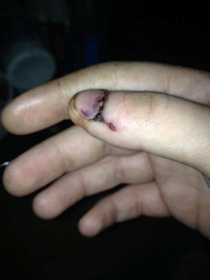 Klemt finger... billede 3