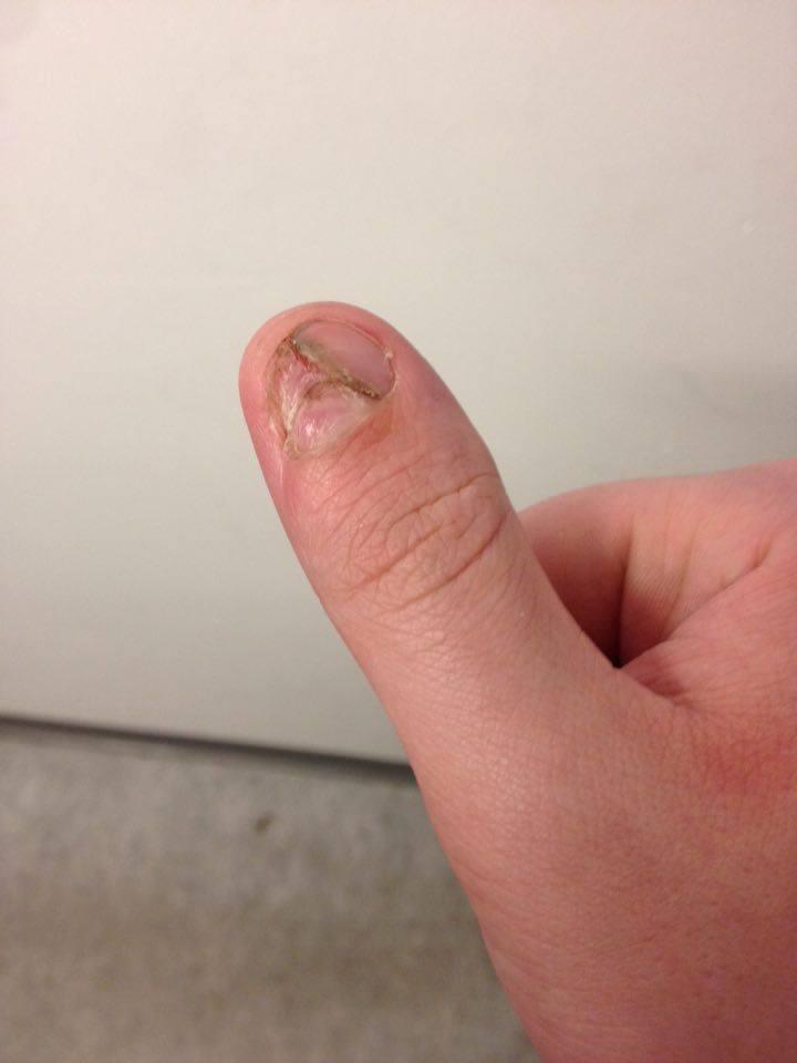 Klemt finger... billede 4