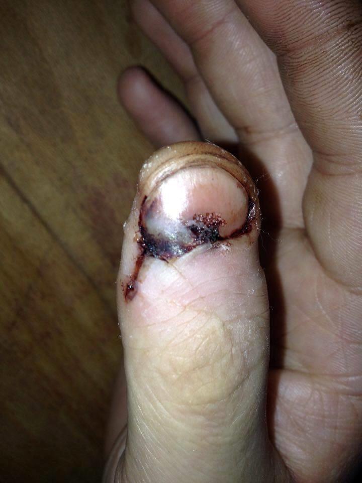 Klemt finger... billede 2