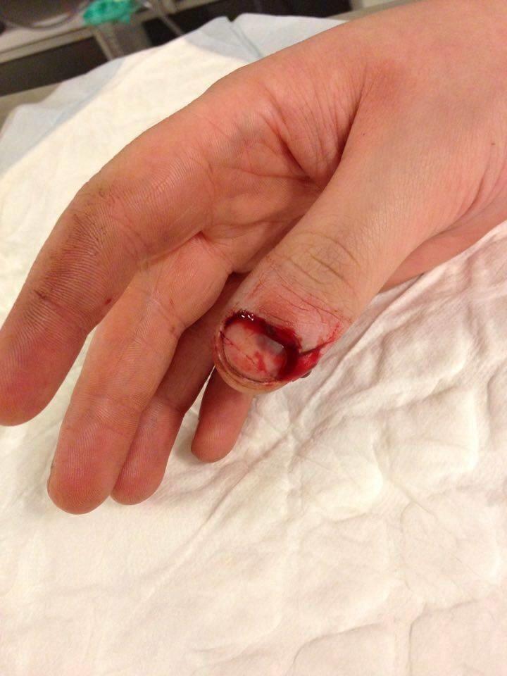 Klemt finger... billede 1