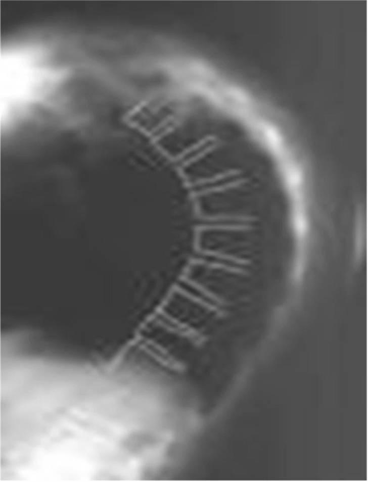 Morbus Scheuermann - min sygdom - Et røngtenbillede. Det er rygraden I kan se, og den er ret bøjet, som I også helt sikkert kan se. billede 5