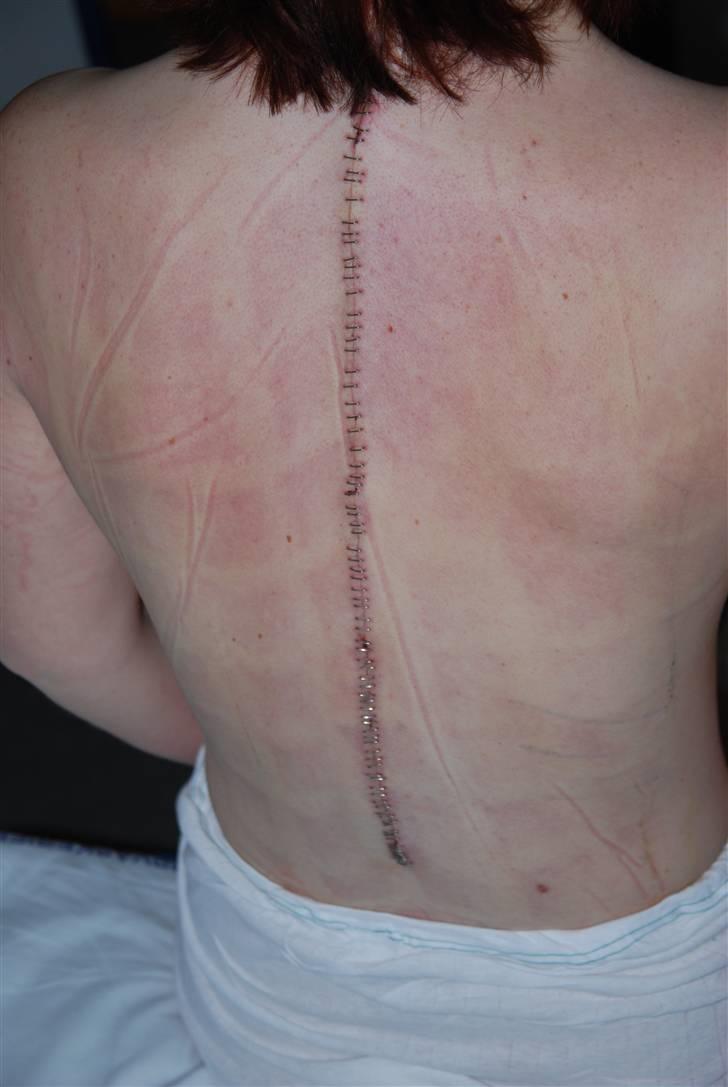 Morbus Scheuermann - min sygdom - Mit sår/ar et par dage efter operationen ;s billede 9