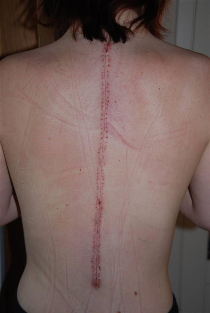 Morbus Scheuermann - min sygdom - Sådan så mit ar ud, den dag jeg fik mine klipse fjernet. billede 10