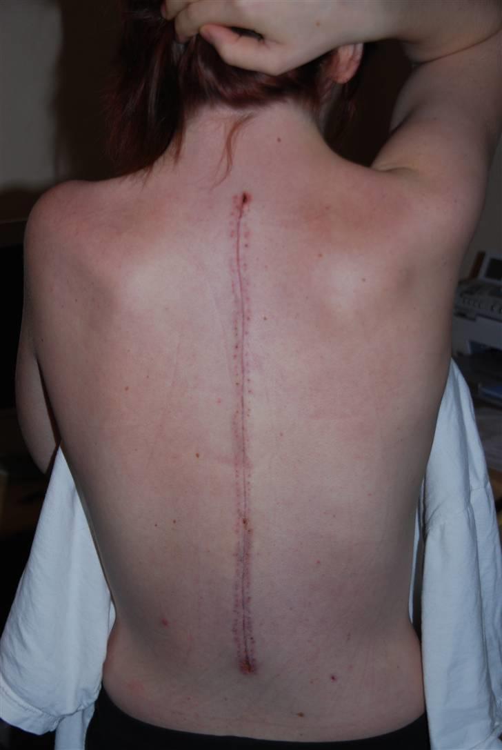 Morbus Scheuermann - min sygdom - Så har klipsene været fjernet i en uge :o) billede 11