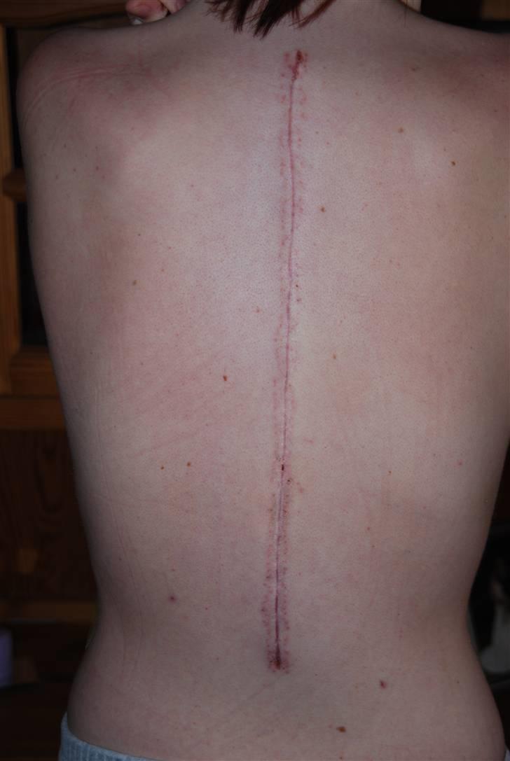 Morbus Scheuermann - min sygdom - Så er det 14 dage siden at klipsene blev fjernet. billede 12