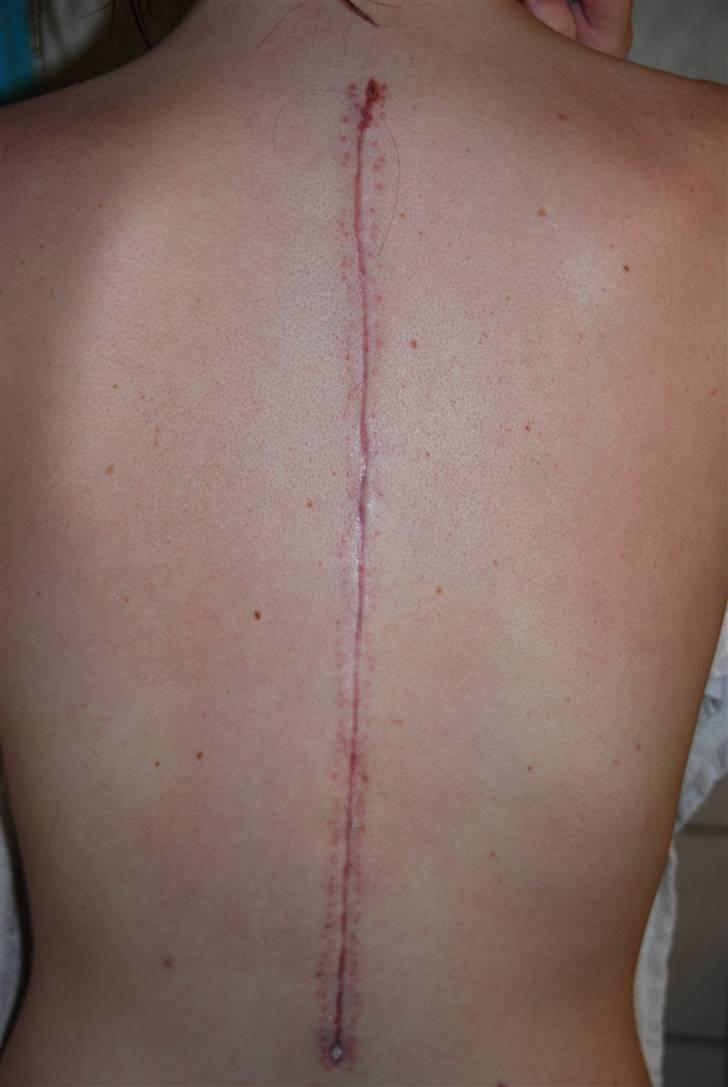 Morbus Scheuermann - min sygdom - Så er det 3 uger siden at klipsene blev fjernet .. Det er sådan min ryg ser ud nu. billede 13