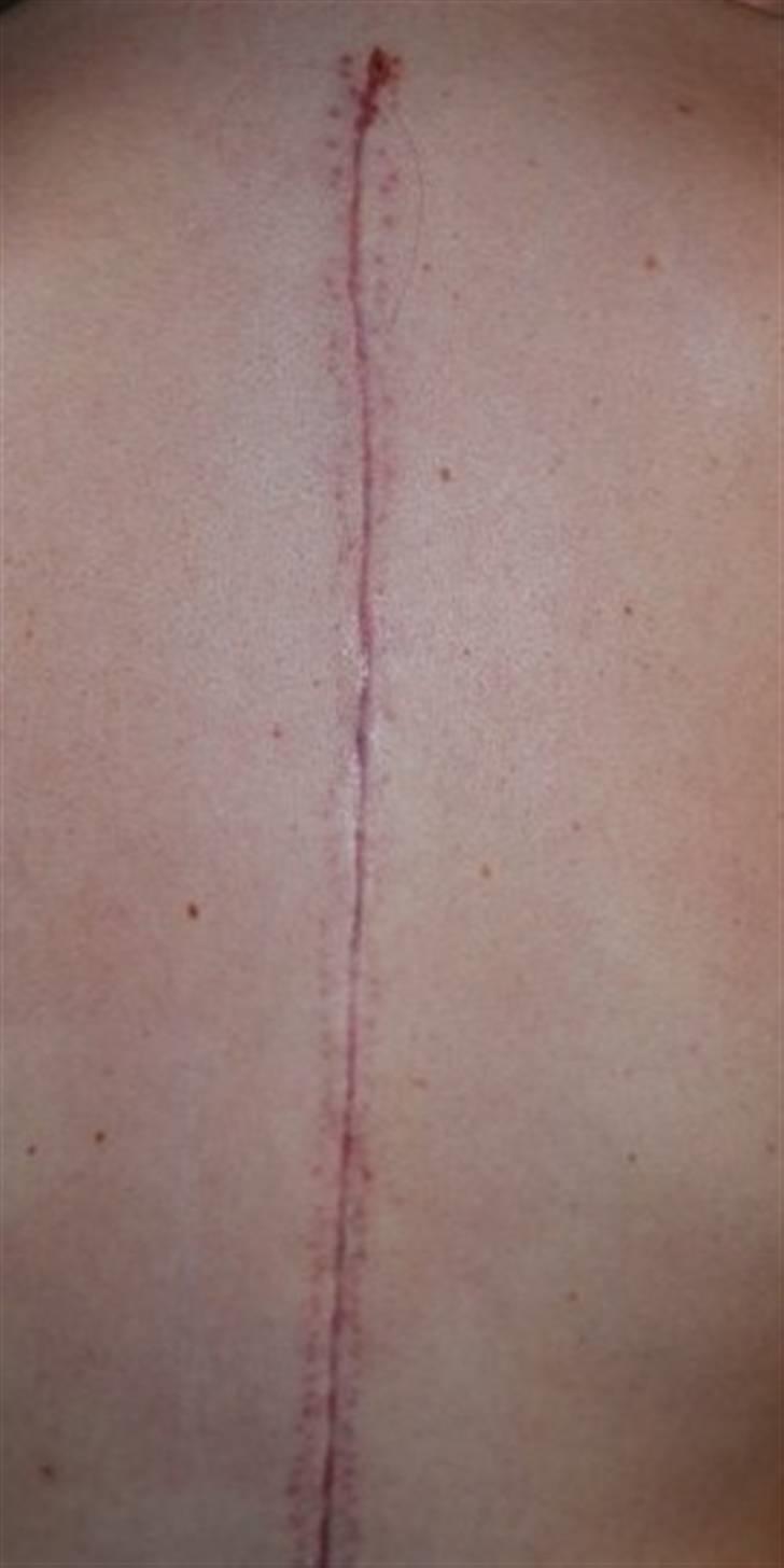 Morbus Scheuermann - min sygdom billede 21