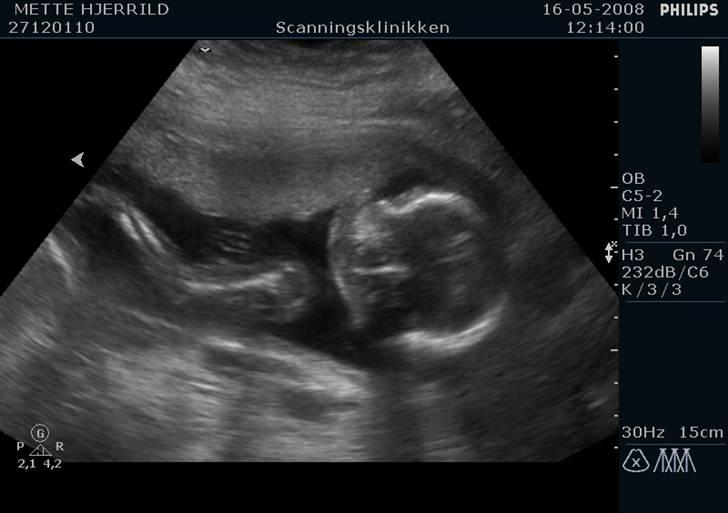 Prinsesse Sofie - Scanning i uge 19 billede 1
