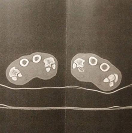 Fjernelse af knogle i forpote grundet brækket tå