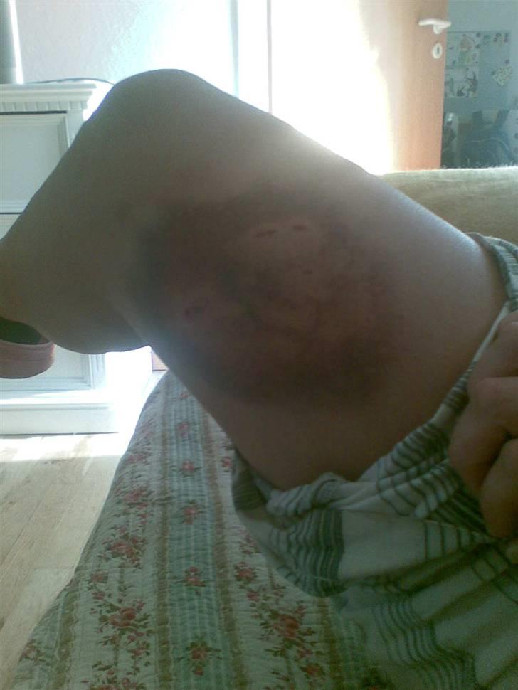 Rottweiler Dikadiabolos Ukita R.I.P - Dette er en veninde der er blevet bidt af en sindsyg hund, og jeg mener sindsyg billede 11