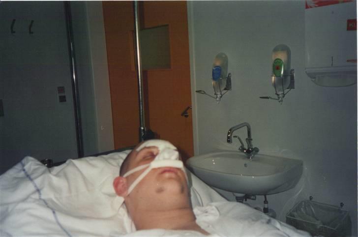 Mit uheld i 99  - 14 dage efter, næsen skulle forsøges rettes op.   hehe det lykkedes dem ikke helt billede 5