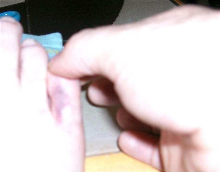 Sådan fixer man en brækket tå.. - Ta fat i den trælse tå, træk i den og sørg for den peger i samme retning som de andre.
Hvis du er i tvivl kig på den anden fod, bare husk det er spejlvendt.
 billede 3