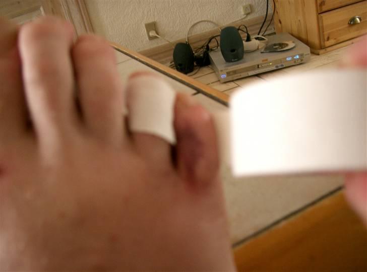 Sådan fixer man en brækket tå.. - Når tåen har den rigtige retning, så sæt den sammen med den raske nabo med sportstape. billede 4