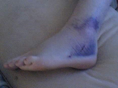 Aprilia sonic(DØD.'(  - min fod efter jeg kørte galt på min jog (den jog som har sonic motoren på) billeder kommer a joggen når den er pæn igen hehe billede 9