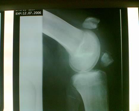 Aprilia Sonic GP ( SOLGT )  - Min knæskald efter uheld den 21 april, har gået med det i ca 3 måneder :/ og er blevet operert D.13 Juli billede 5