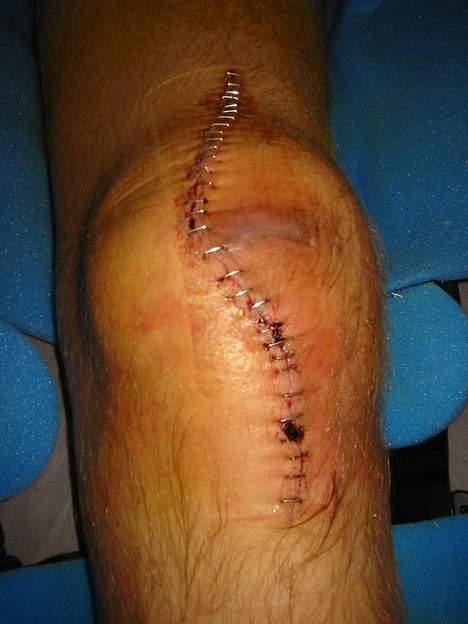 Aprilia Sonic GP ( SOLGT )  - De har samlet min knæskald som var i 2 stykker, og har ikke brugt tråd til at samle det med , men klips :/  billede 6