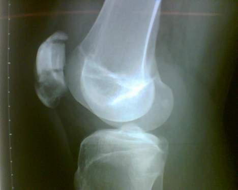 Aprilia sonic !!!!! DØD !!!!! - her kan i se mit knæ efter uheldet.. læg mærke til knæskallen som er flækket 3 steder! billede 18