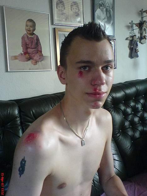 Yamaha Bump - Projekt - Styrt på dirtbike - 15 april 2007. Slap heldigt! billede 19