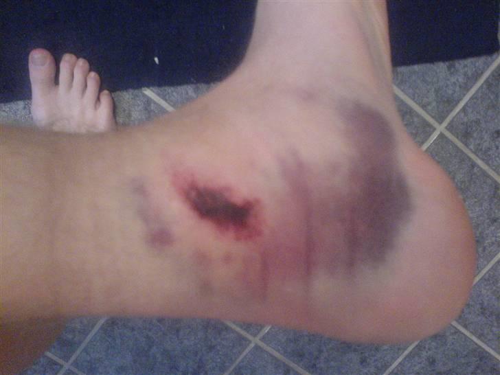 Suzuki Street magic Solgt ! - min fod efter jeg blev kørt over på joggen ! billede 6